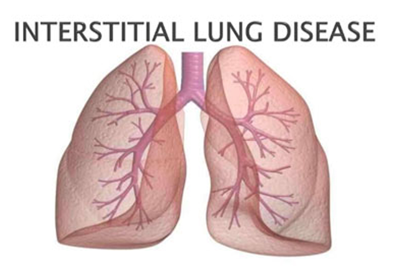 Interstitial Lung Disease