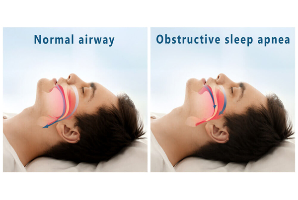 Sleep Apnea